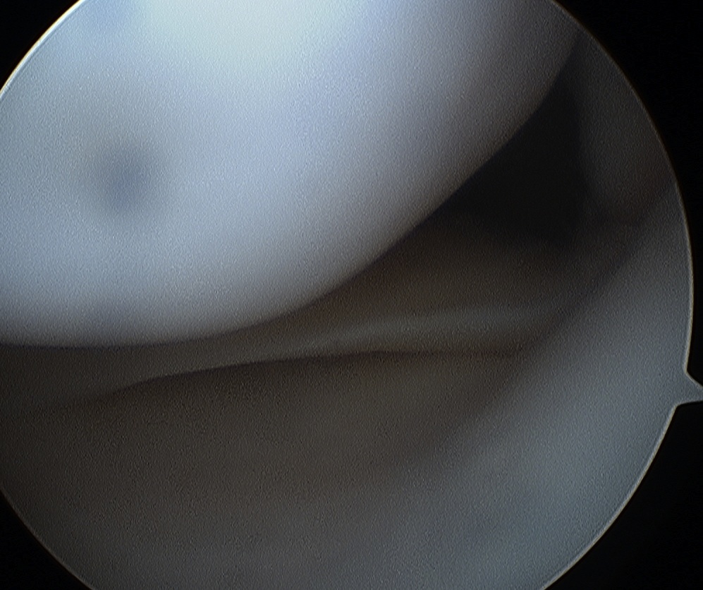 Posterior Horn Medial Meniscus Normal